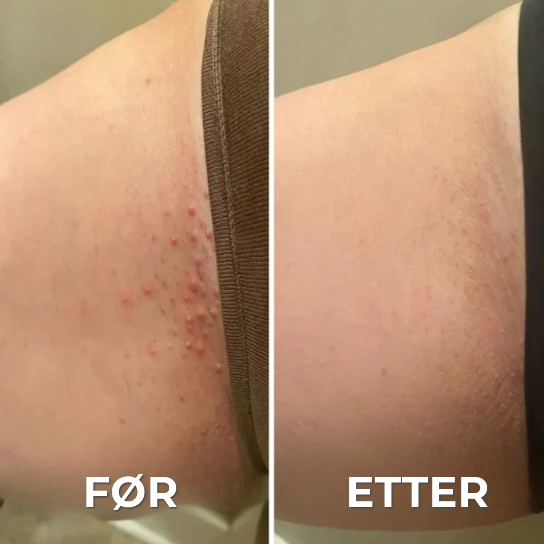 Profesjonell Anti-Utslett Barbermaskin