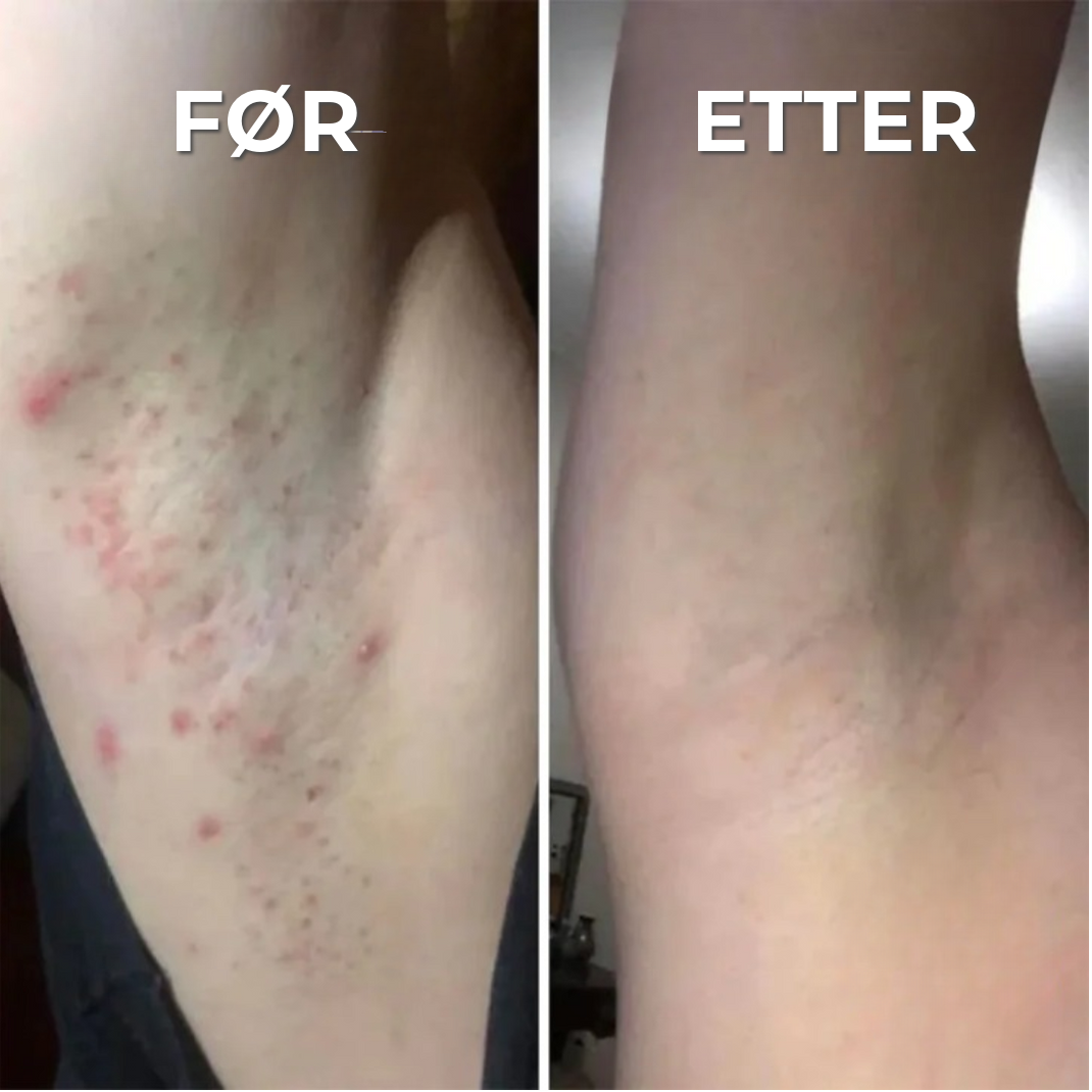 Profesjonell Anti-Utslett Barbermaskin